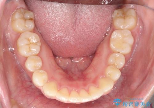 矯正治療後の後戻り インビザラインにて再矯正の治療後