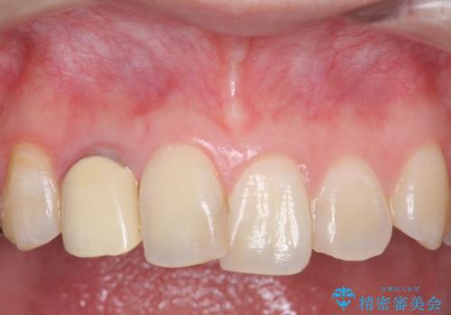 オールセラミッククラウン 被せ物の継ぎ目が気になるの症例 治療前