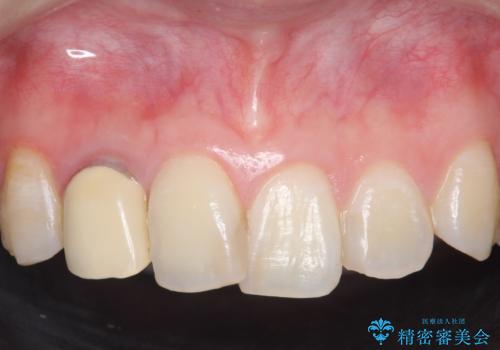 オールセラミッククラウン 被せ物の継ぎ目が気になるの治療前