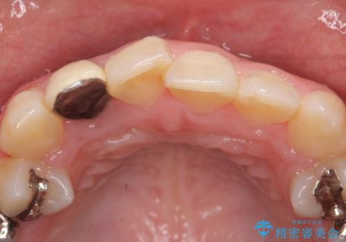 オールセラミッククラウン 被せ物の継ぎ目が気になるの治療前