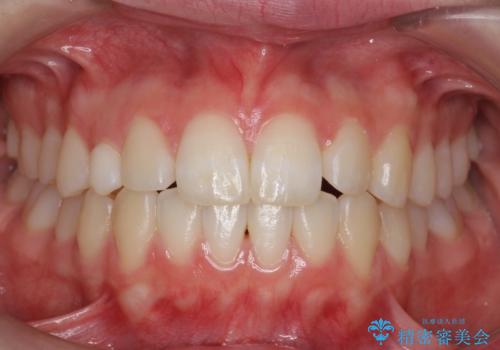 前歯のがたつき　乳歯を抜かずに矯正の症例 治療後