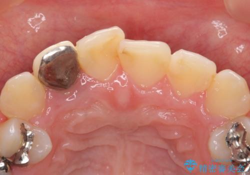 オールセラミッククラウン 被せ物の継ぎ目が気になるの治療前