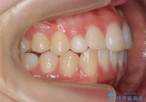 前歯のがたつき 乳歯を抜かずに矯正の治療後