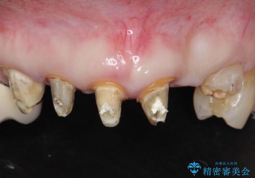 20年前に被せた前歯をやりかえたい 60代女性の治療中