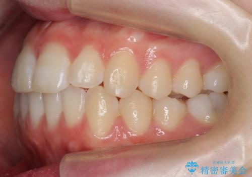 前歯のがたつき 乳歯を抜かずに矯正の治療後