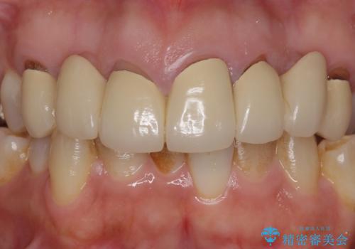 オールセラミッククラウン 前歯の被せ物を綺麗にの治療前