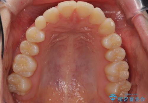 前歯のがたつき 乳歯を抜かずに矯正の治療後