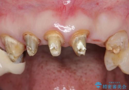 20年前に被せた前歯をやりかえたい 60代女性の治療中