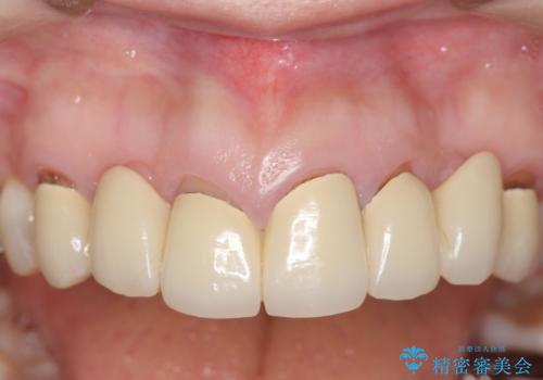 オールセラミッククラウン　前歯の被せ物を綺麗にの症例 治療前