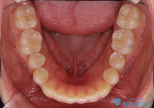 前歯のがたつき 乳歯を抜かずに矯正の治療後