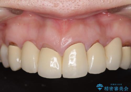 オールセラミッククラウン 前歯の被せ物を綺麗にの治療前