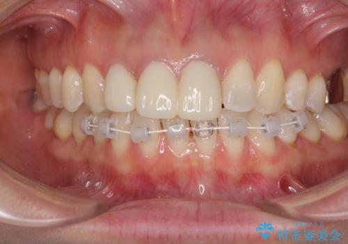 前歯の審美歯科治療　オールセラミッククラウンと部分矯正の治療中