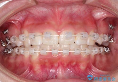 前歯のがたつき・出っ歯 ワイヤーによる抜歯矯正の治療中