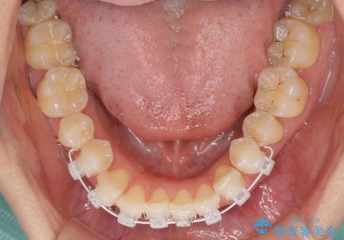 前歯の審美歯科治療　オールセラミッククラウンと部分矯正の治療中