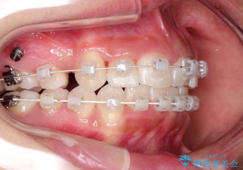 前歯のがたつき・出っ歯　ワイヤーによる抜歯矯正の治療中