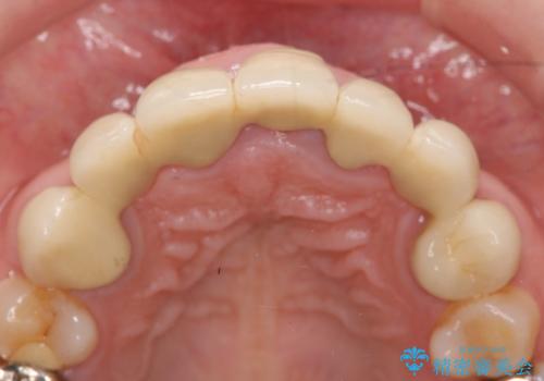 オールセラミッククラウン 前歯の被せ物を綺麗にの治療前
