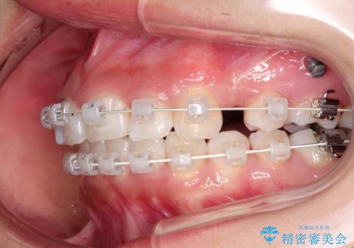 前歯のがたつき・出っ歯 ワイヤーによる抜歯矯正の治療中