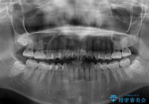 気になる前歯をインビザラインで綺麗にの治療前