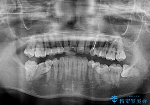 奥歯の倒れた歯を改善 インビザラインでの矯正治療の治療前