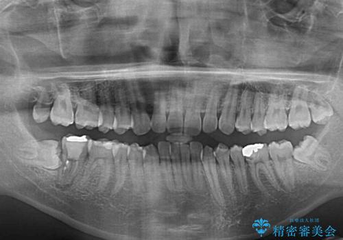 口が少し閉じにくい インビザラインによる非抜歯矯正の治療前