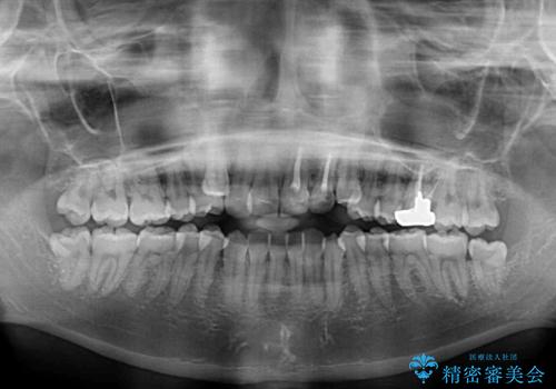 八重歯の抜歯矯正 費用を抑えた矯正装置の治療前