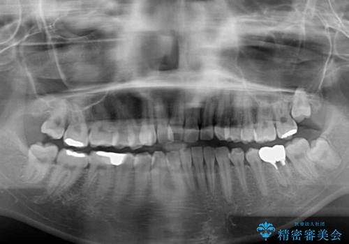 インプラント治療とインビザライン矯正治療 総合歯科治療の治療前