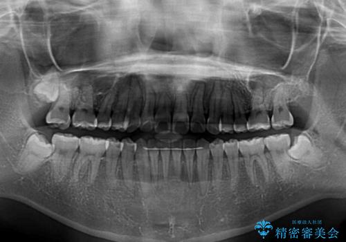 気になる前歯をインビザラインで綺麗にの治療後