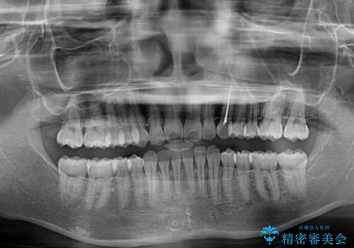 奥歯の倒れた歯を改善　インビザラインでの矯正治療の治療後
