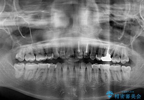 八重歯の抜歯矯正 費用を抑えた矯正装置の治療後