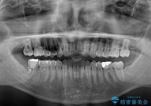 口が少し閉じにくい インビザラインによる非抜歯矯正の治療後