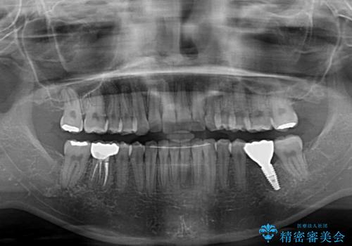 インプラント治療とインビザライン矯正治療 総合歯科治療の治療後