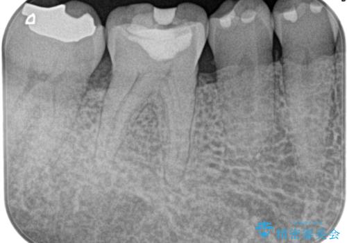 奥歯が痛い。精密根管治療〜オールセラミッククラウンの治療前