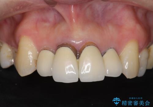 前歯の黒ずみ　セラミッククラウン改善の症例 治療前