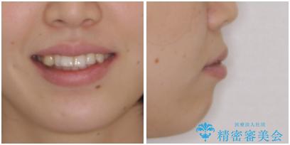 インプラント治療とインビザライン矯正治療 総合歯科治療の治療前(顔貌)