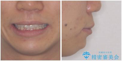 口が少し閉じにくい インビザラインによる非抜歯矯正の治療前(顔貌)