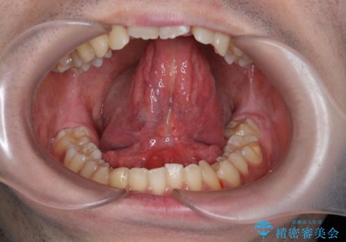 滑舌の改善　舌小帯の形成の治療後
