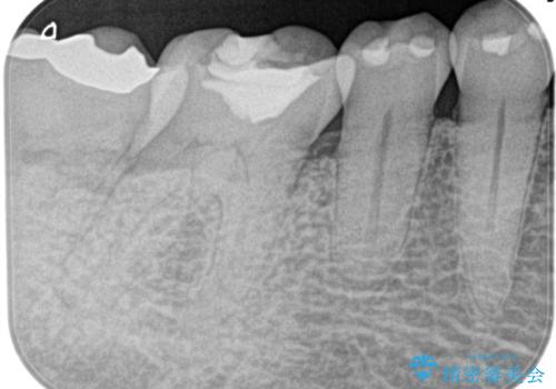 奥歯が痛い。精密根管治療〜オールセラミッククラウンの治療前