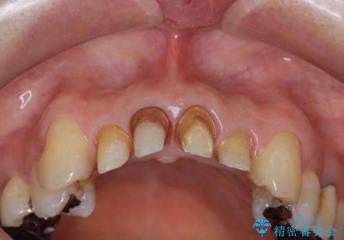 前歯の黒ずみ セラミッククラウン改善の治療中