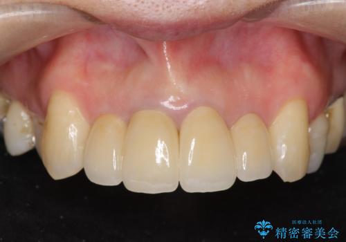 前歯の黒ずみ　セラミッククラウン改善の症例 治療後