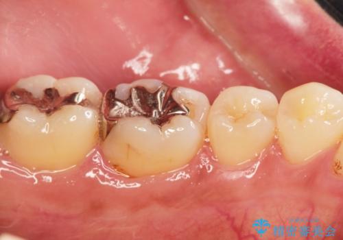 [セラミック治療]  目立つ銀歯を白く②の症例 治療前