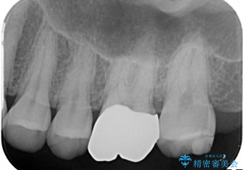 【メタルフリー】銀歯を白くしたい。オールセラミッククラウン。の治療前
