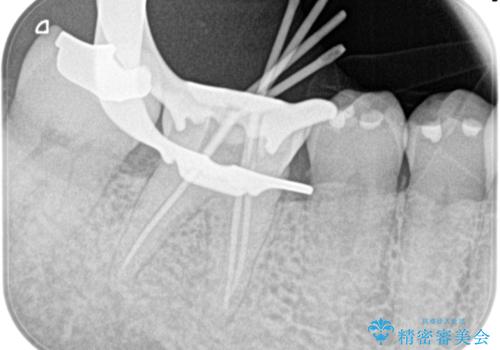 奥歯が痛い。精密根管治療〜オールセラミッククラウンの治療中