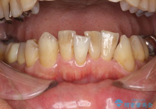 PMTCによるステインの除去の症例 治療前