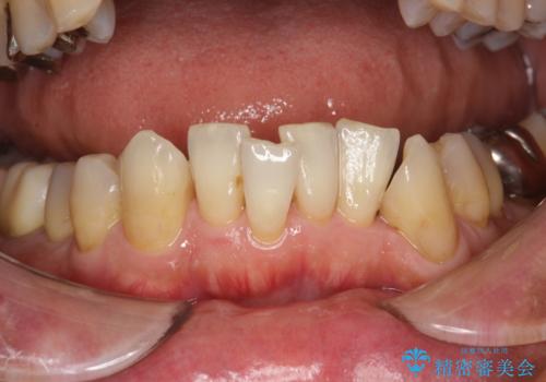 PMTCによるステインの除去の症例 治療後