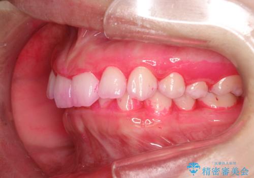 毎月のメンテナンスの治療前