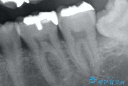 [セラミック治療]  目立つ銀歯を白く②の治療前