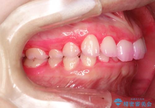 毎月のメンテナンスの治療前