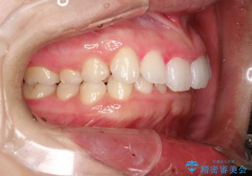 毎月のメンテナンスの治療後