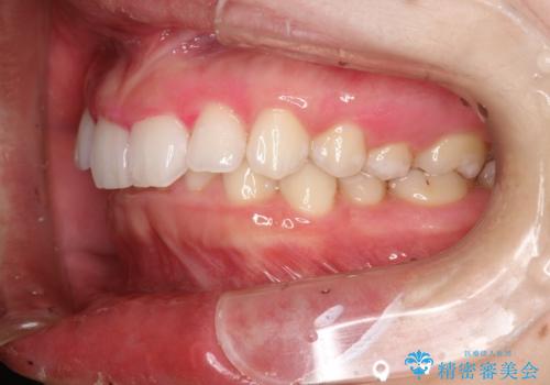 毎月のメンテナンスの治療後