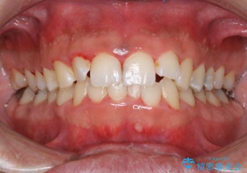 結婚式前にクリーニング希望の方の症例 治療後